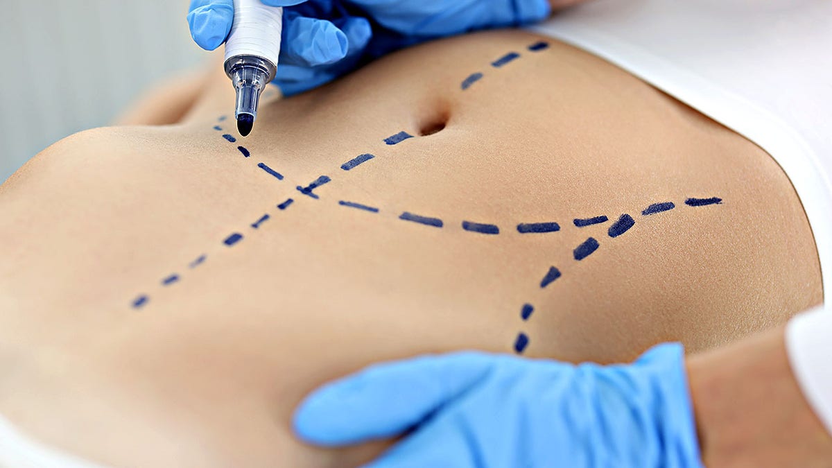 plastic surgeon drafting preoperative markings connected tegument of patient's abdomen