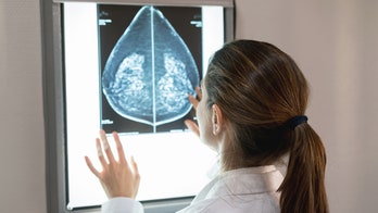 FDA approves first AI tool to predict breast cancer risk