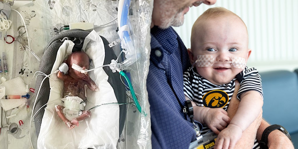 Iowa baby, born at 21 weeks, holds world record as the most
