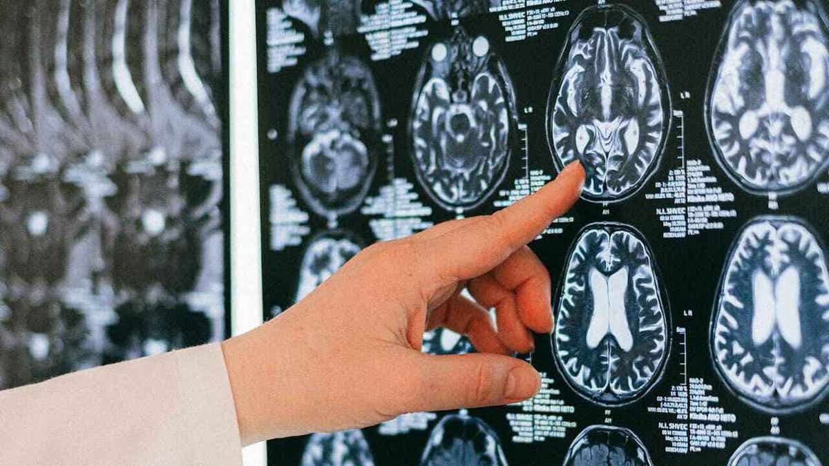 A doctor’s hand pointing at a brain scan.