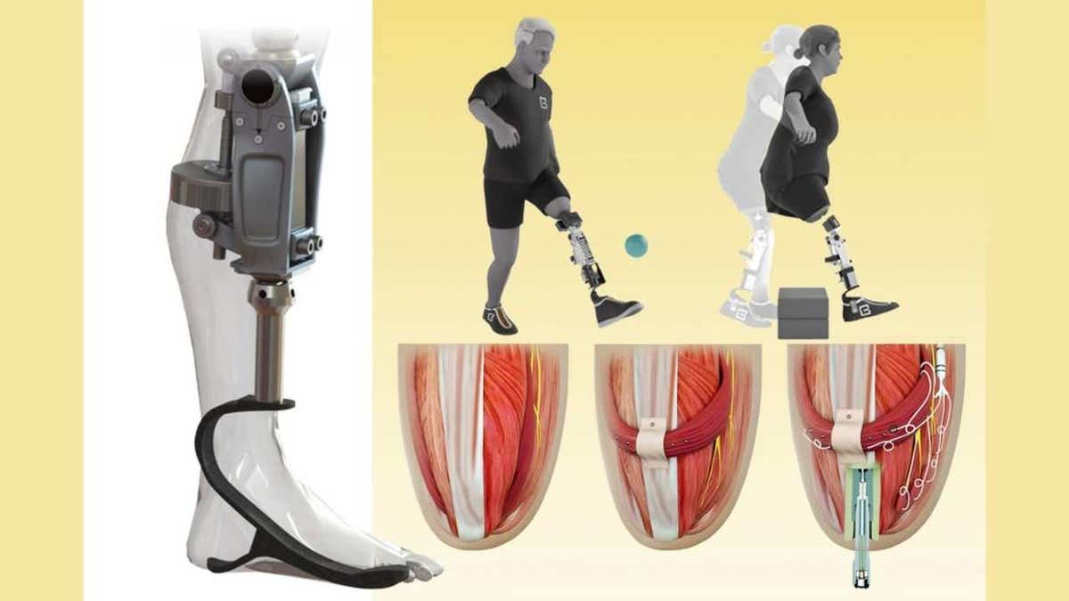 Illustration of a new e-OPRA bionic knee that can help people with above-the-knee amputations.