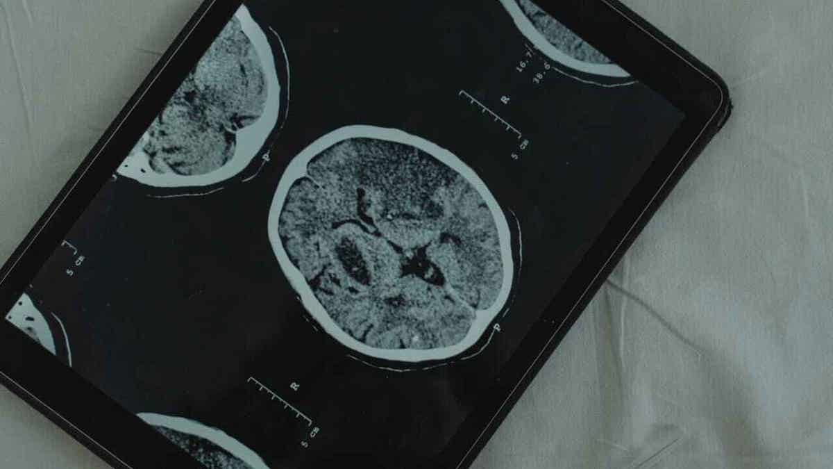 Bir tablet üzerinde taranmış bir beynin görüntüsü.