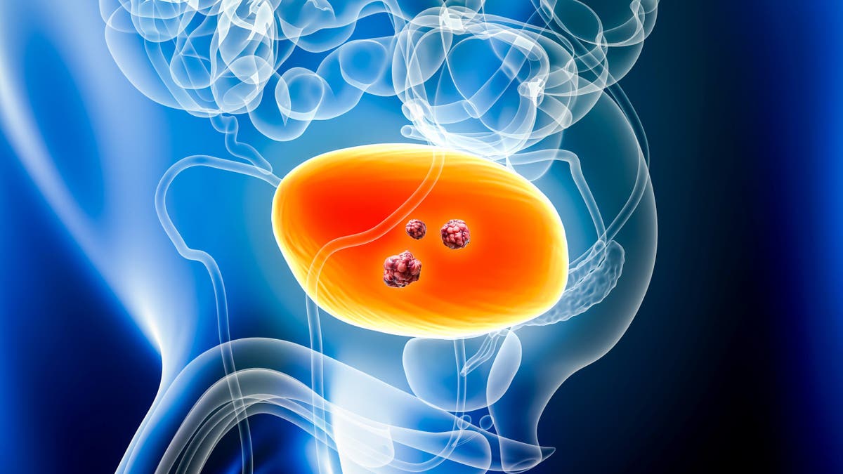 Bladder cancer concept