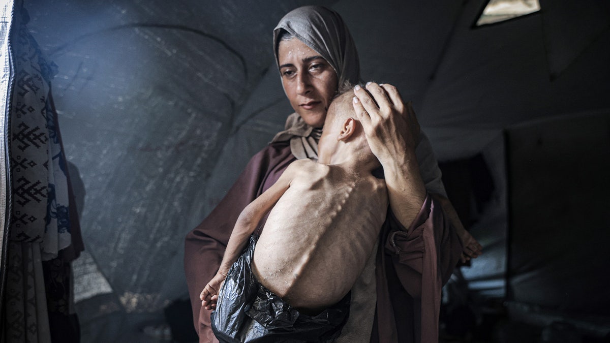 A Palestinian child faces life-threatening malnutrition due to Israeli attacks and blockade, on July 21, 2025.