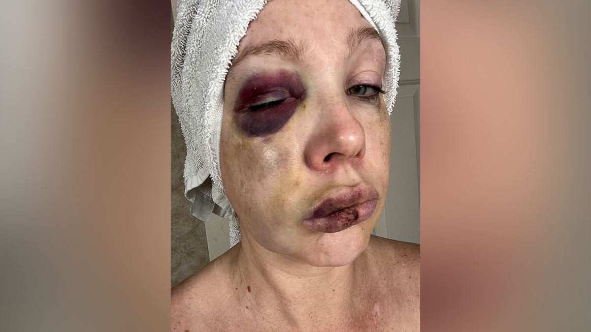 The abused and hurtful face of the Cincinnati beat-beat victim is known only as Holly.