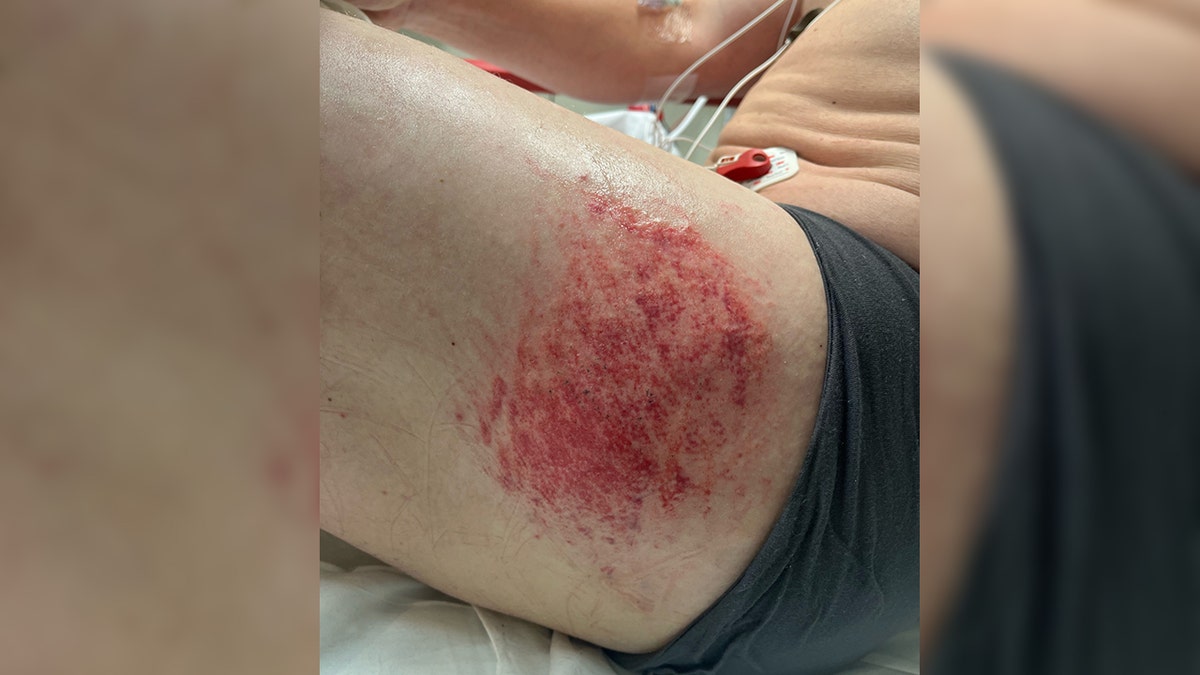 scraped, bloody thigh of ICE agent