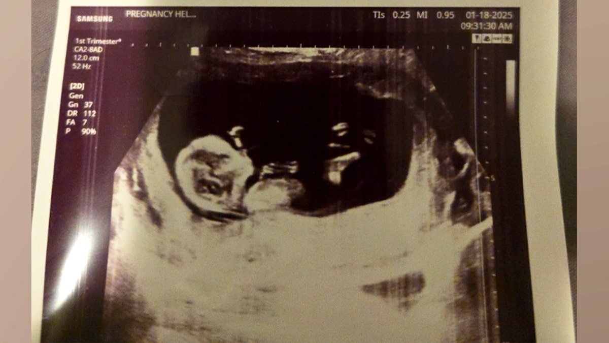 Ultrasound image of unborn baby boy in Texas abortion pill lawsuit filed against California doctor