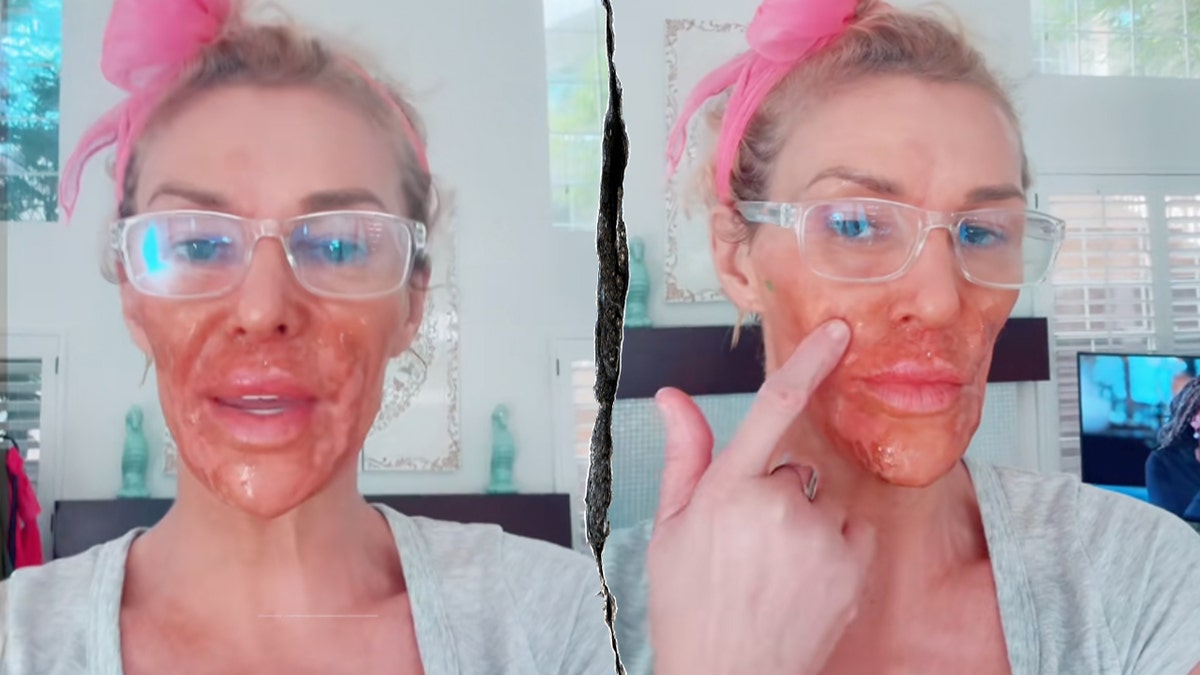 Brandi Glanville face damage.