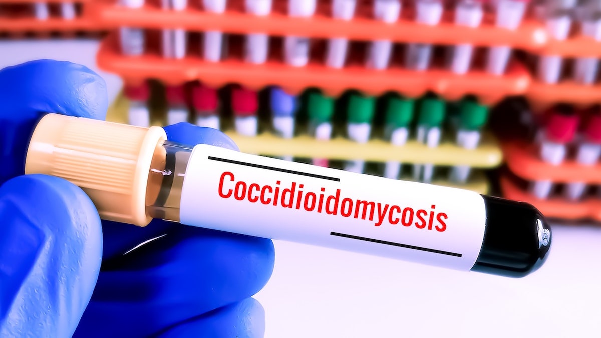 Coccidioidomycosis fungal disease Valley fever