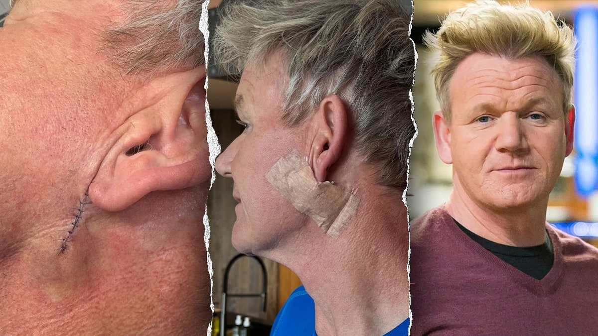 Split photos of Gordon Ramsay and close-ups of his skin cancer surgery.