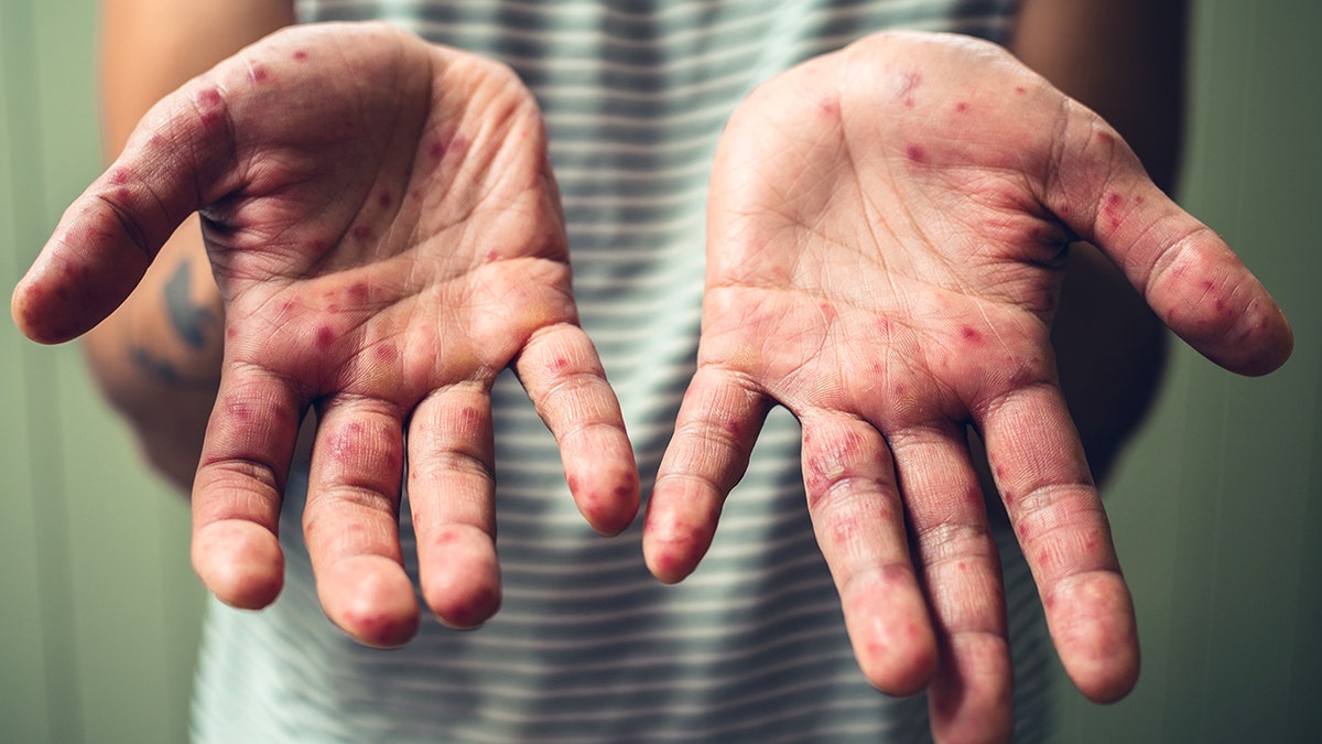A young man is showing his hands with spots and rash from hand foot and mouth disease