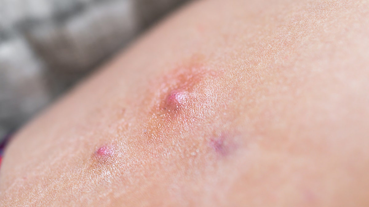 hidradenitis suppurativa bumps on skin