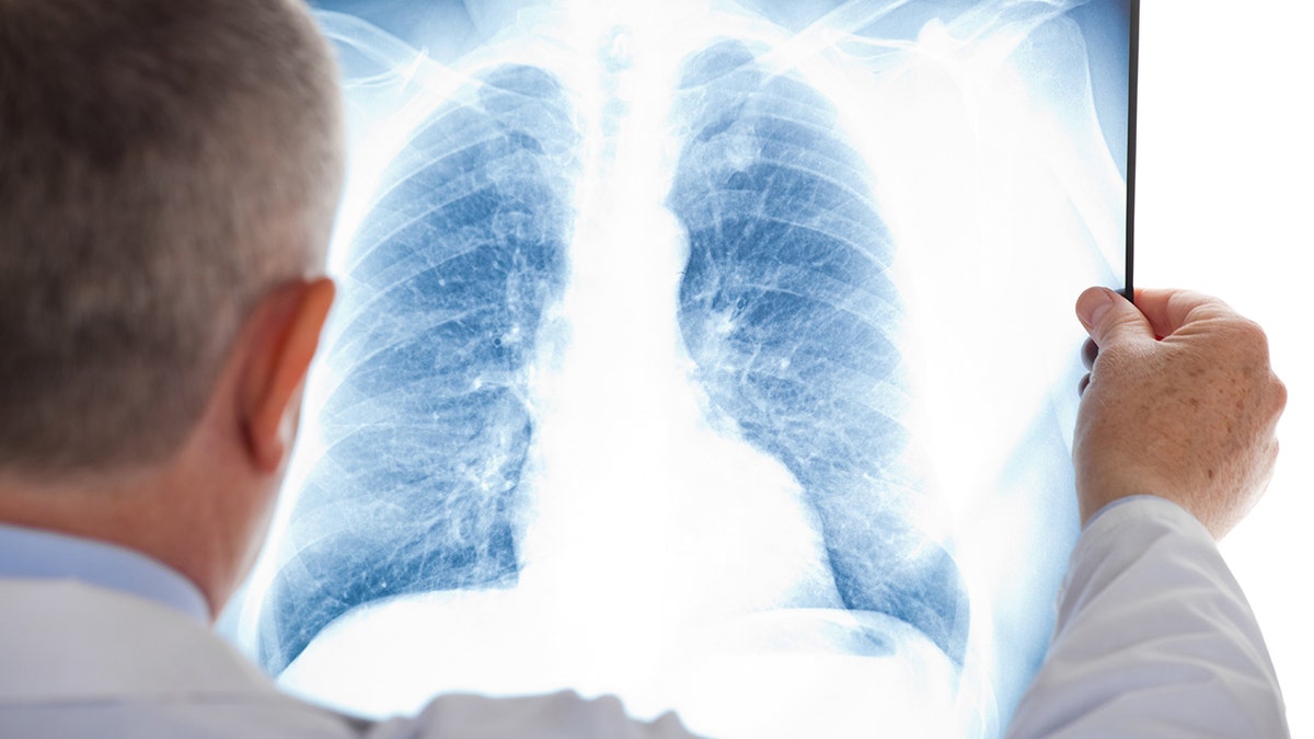 Doctor examining a lung radiography.