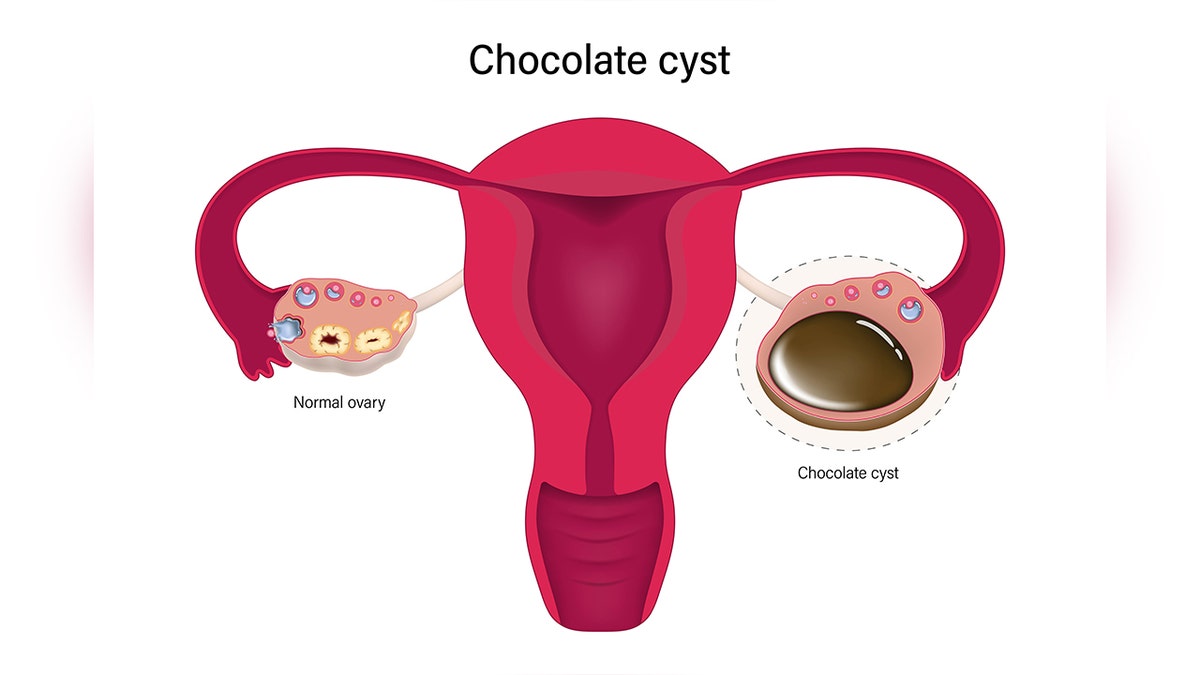A visual depiction of chocolate cysts, the growth Bindi Irwin claims doctors removed to treat her endometriosis.