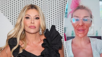 Brandi Glanville suffers severe chemical burns on her face while trying to self-treat mystery illness