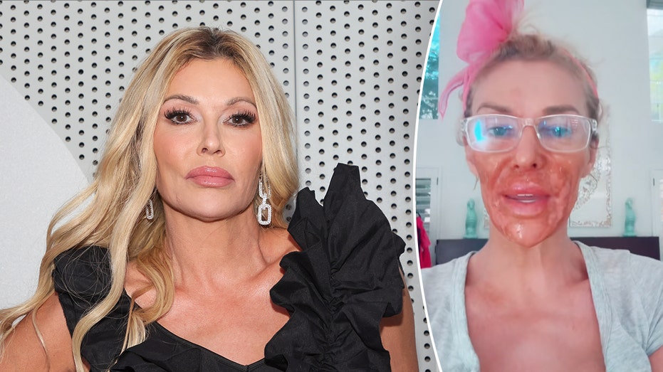 Brandi Glanville suffers severe chemical burns on her face while trying to self-treat mystery illness