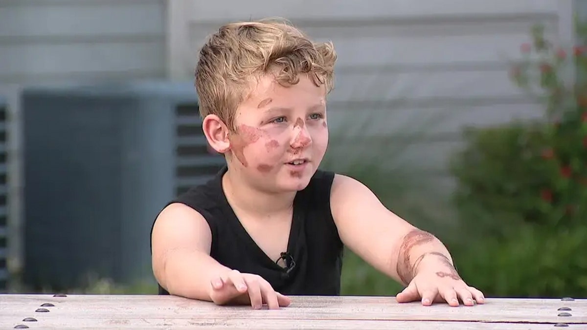 young boy with large abrasions on face and arm