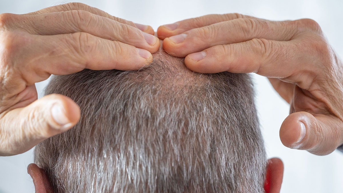 man touching his bald spot
