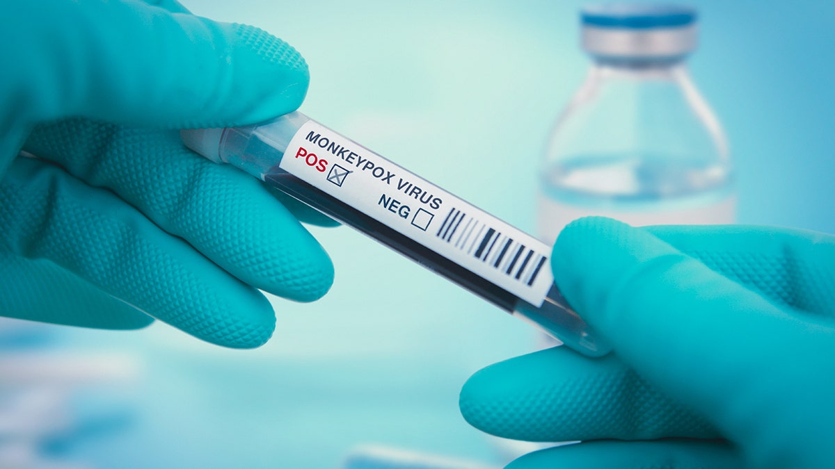 monkeypox virus test in medic's hand