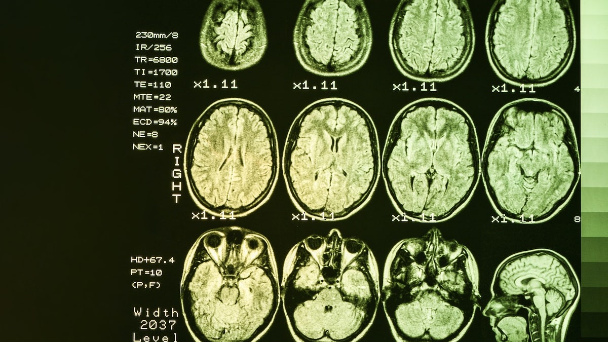 MRI brain scans
