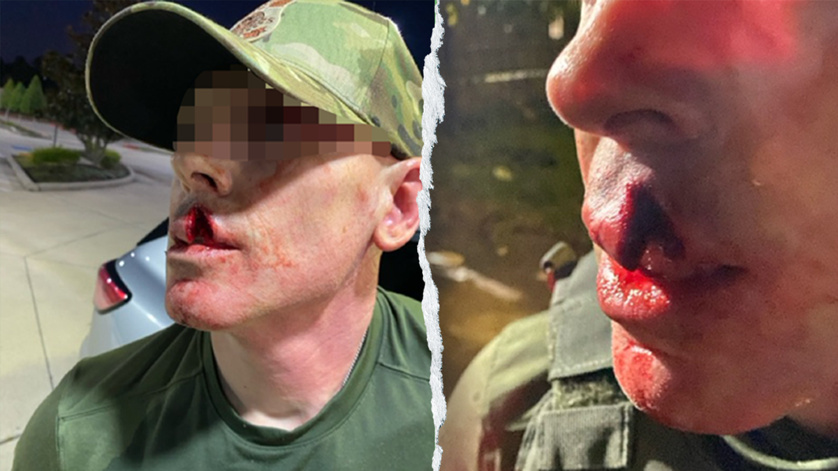 Close ups of ICE agent injuries