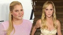 What to know about Cushing’s syndrome, which led to Amy Schumer's dramatic weight loss