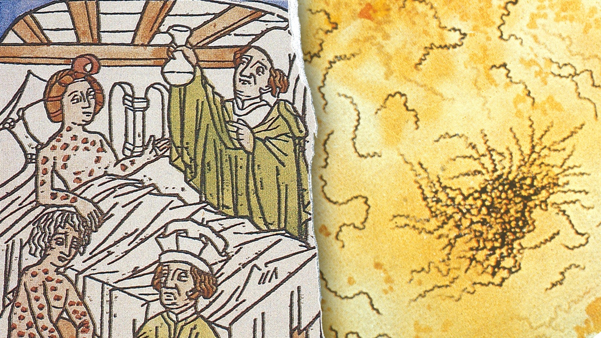 Split image of medieval depiction of syphilis treatment, syphilis bacteria