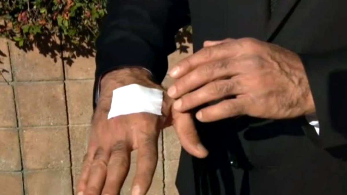 Calor Madanescht shows bandaged hand