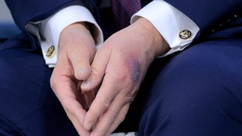 White House explains bruise on Trump's hand that drew Davos attention - Fox News