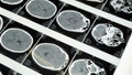 China&rsquo;s ultrasound brain tech race heats up - Fox News
