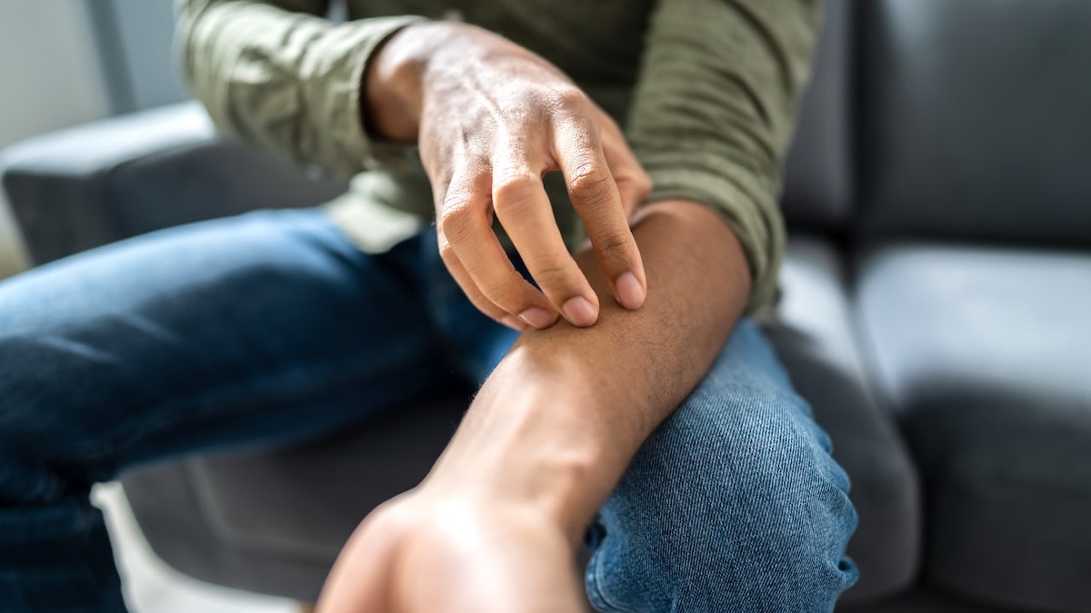 Man scratching arm - skin rash