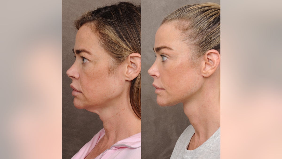 Angled side-view before-and-after images of a Denise Richard’s face and neck, showing a more sculpted jawline and tighter skin.