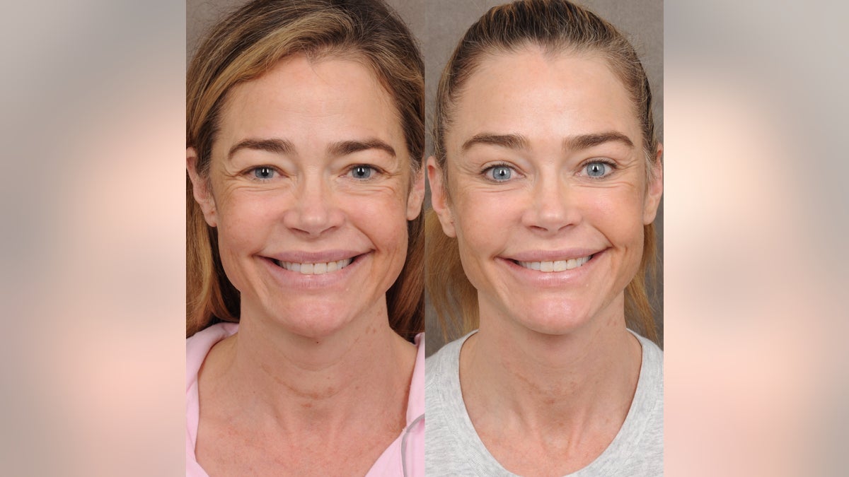 Before-and-after front-facing images of a smiling Denise Richards, showing reduced lines and improved facial firmness.