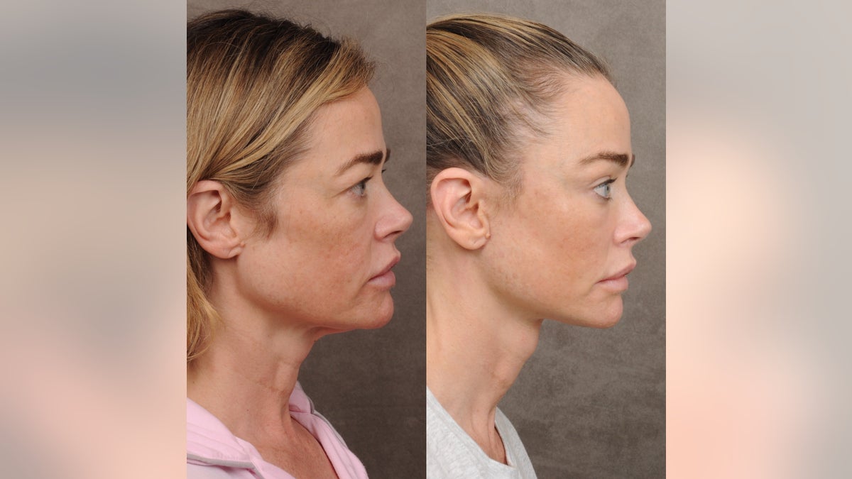 Side-by-side profile view of Denise Richards' face and neck before and after treatment, showing a more defined jawline and tighter neck.