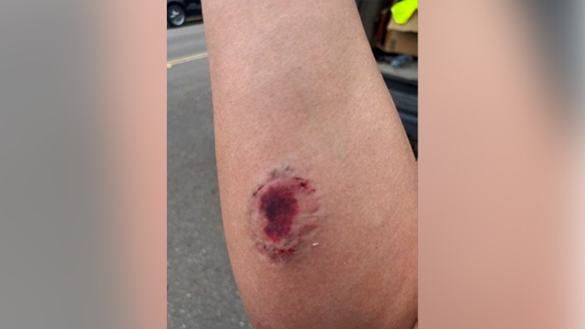 Bite marks on person's forearm