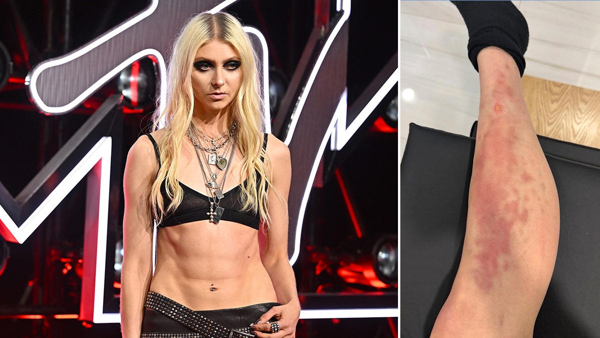 Taylor Momsen rushed to hospital after venomous spider bite during AC/DC tour