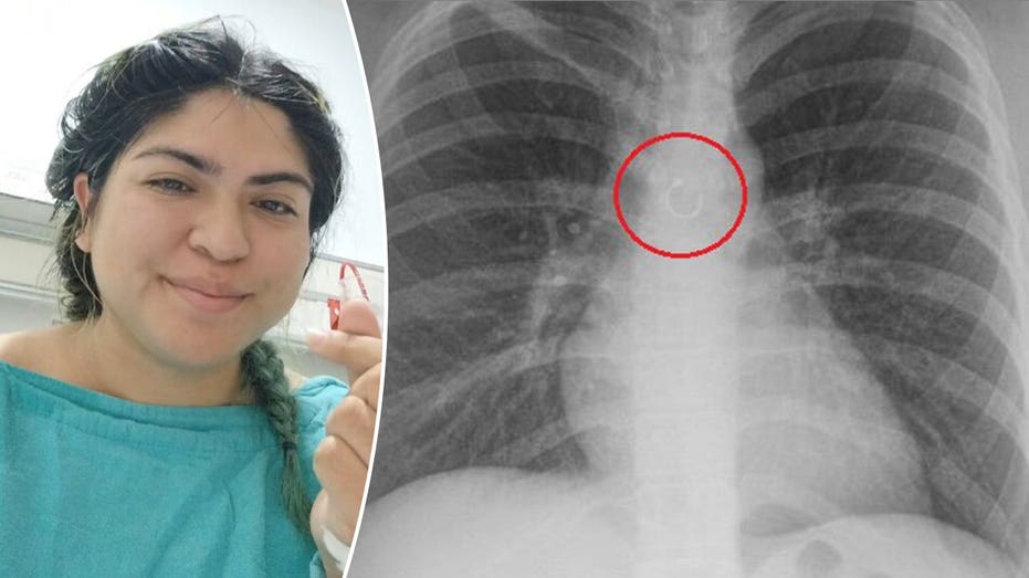 Woman discovers missing nose ring traveled to her lungs, causing month-long cough