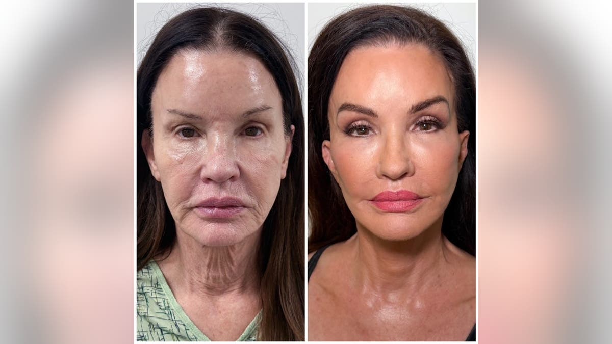 Janice Dickinson posa en unas fotos de comparación facial de antes y después tomadas de perfil.