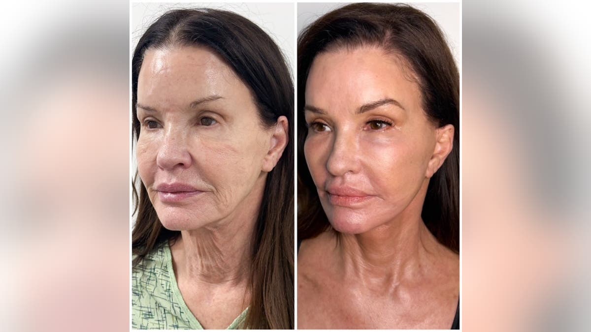 Janice Dickinson posa ante la cámara en unas fotos comparativas del antes y el después de su tratamiento facial.