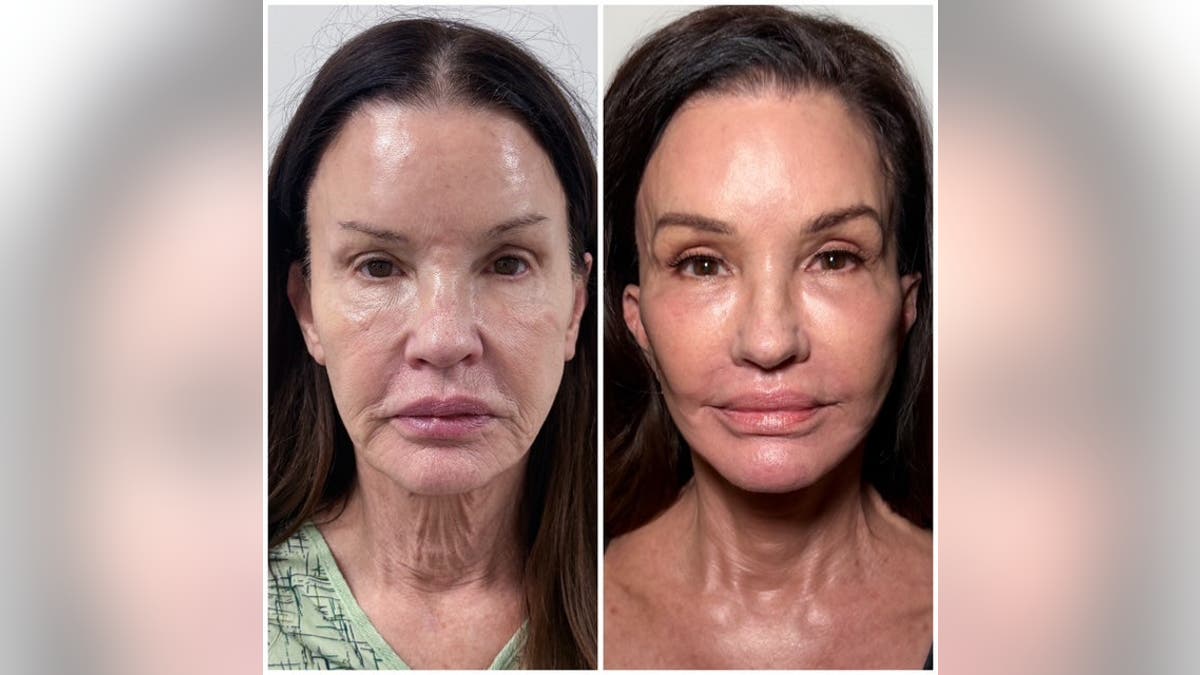 Janice Dickinson posa ante la cámara en unas fotos comparativas del antes y el después de su tratamiento facial.