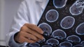 Los médicos pensaban que un hombre tenía cáncer cerebral, pero en realidad le encontraron tenias vivas - Fox News