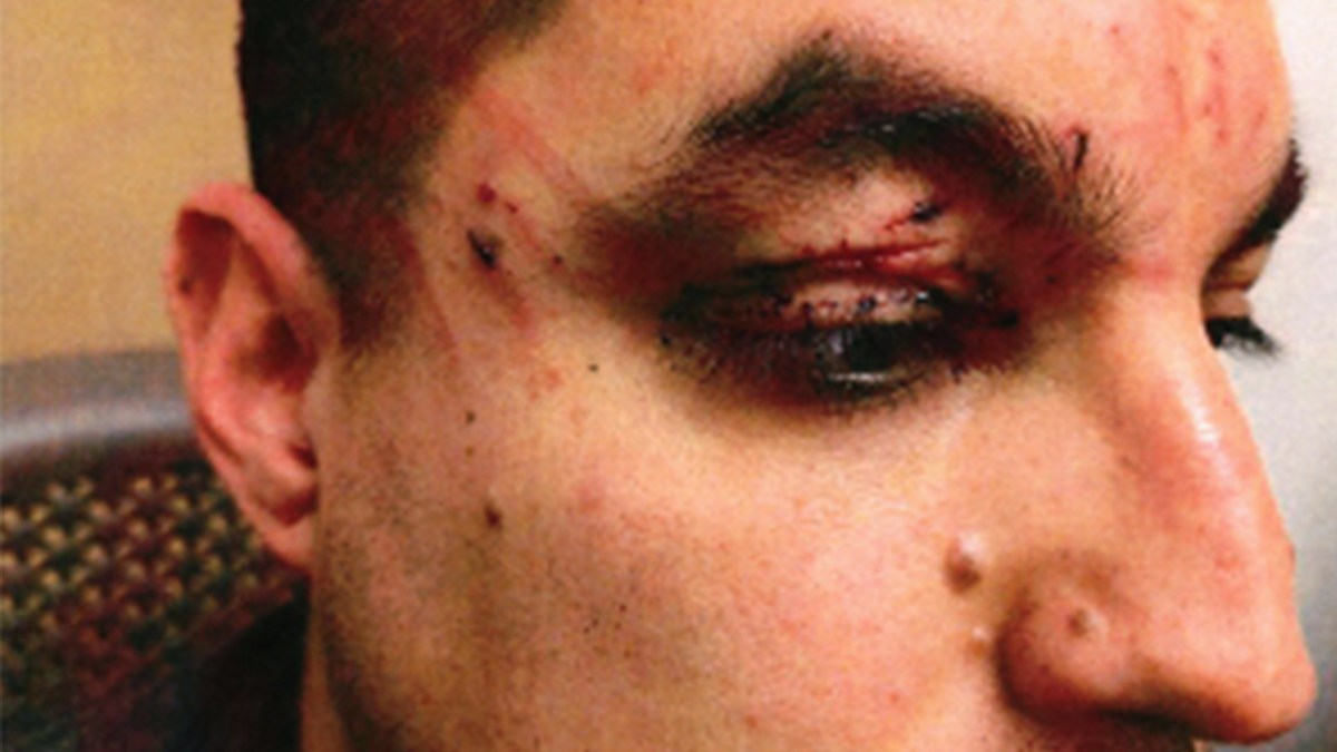 Victim's eye injury after flight attack.