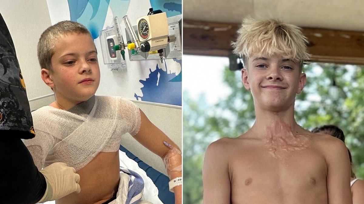 Teen at the hospital after suffering third-degree burn on chest.