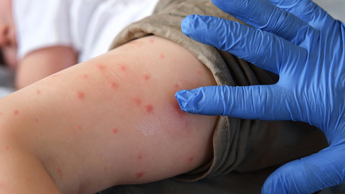 Doctor examines child's leg with red rash and skin irritation.