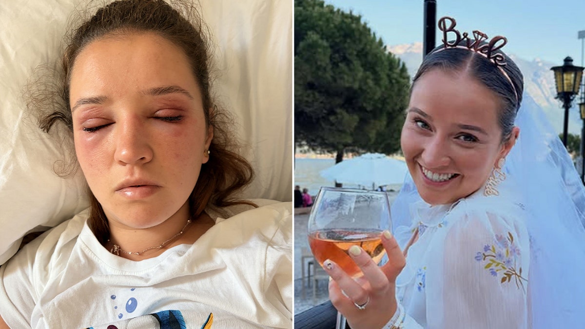 Polly Bibby red eye reaction from eyelash extensions ahead of her wedding day.