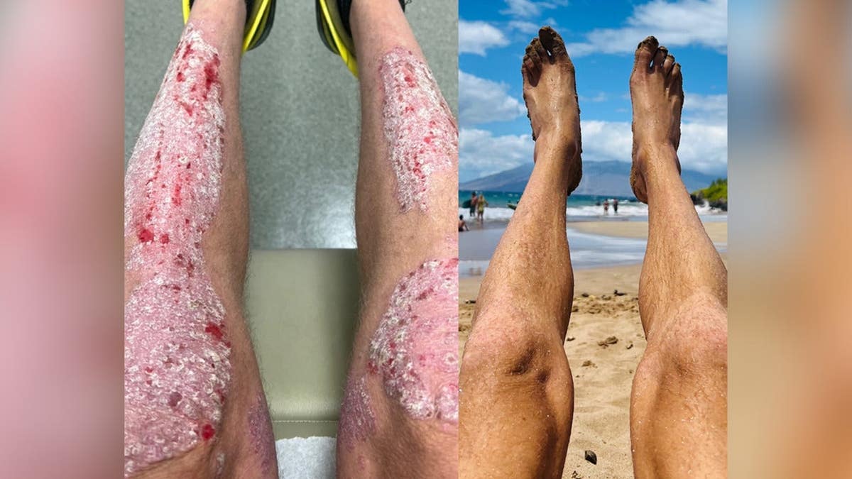 Lashbrook's legs with psoriasis sores at left, and cleared at right