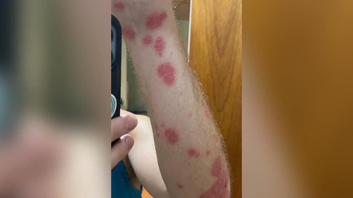 Stephen Lashbrook's forearm covered with psoriasis sores.