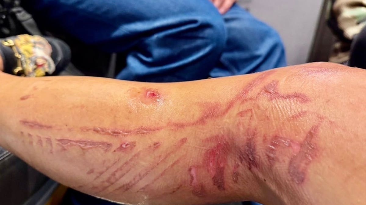 Nicole took a photo of her severe arm burns.