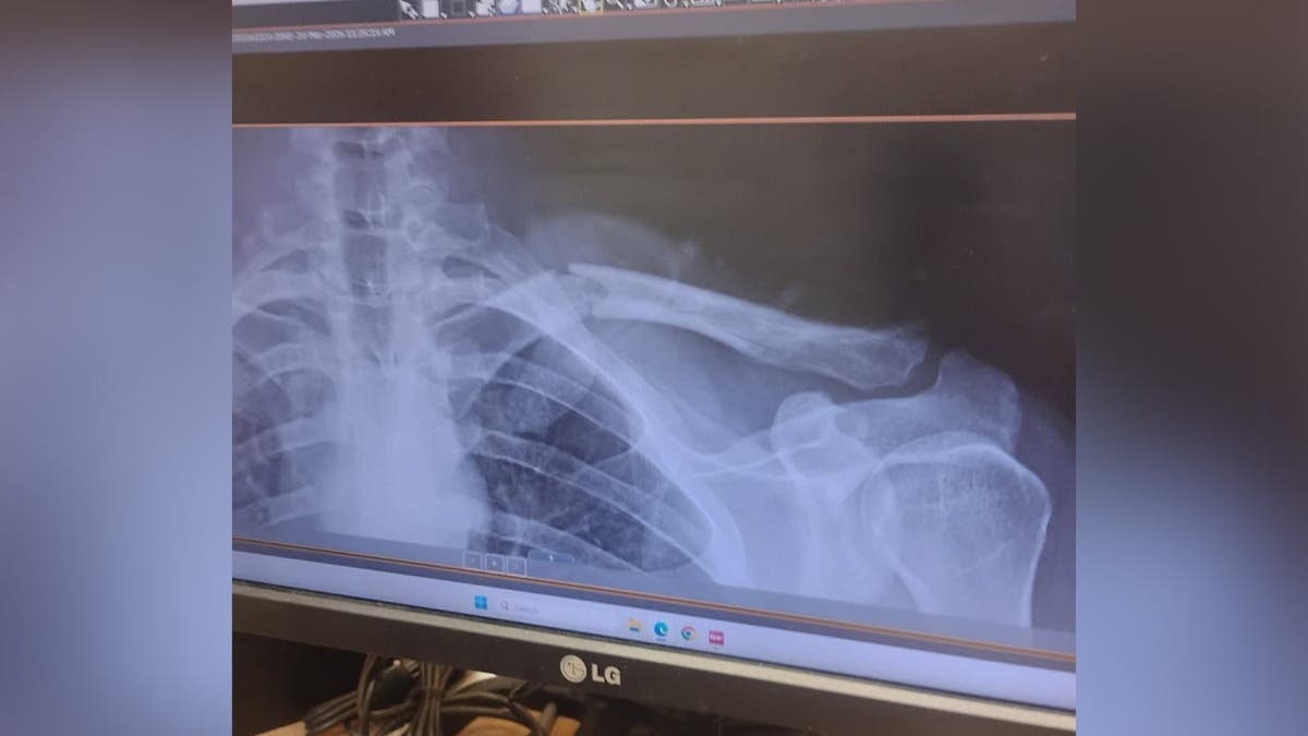 image shows x-ray of collar bone