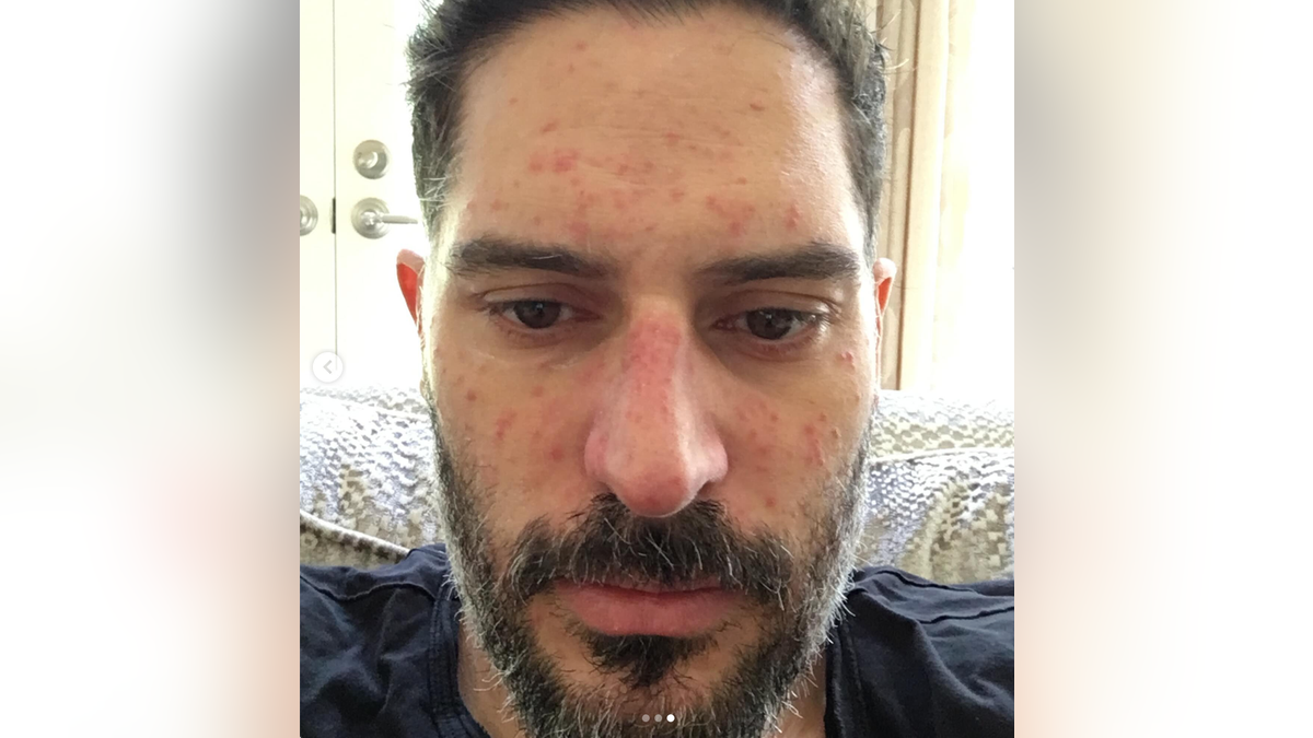 Joe Manganiello skin issues